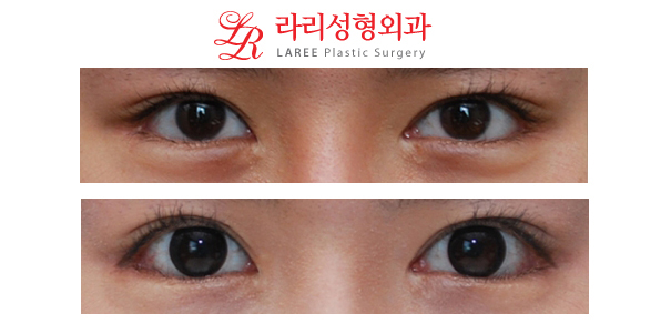 부작용없는 눈꼬리내리기뒤트임재수술 효과 관련 이미지 1