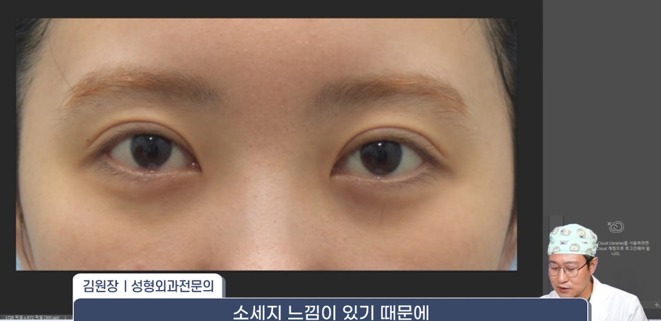[라리성형외과] 쌍꺼풀재수술 라인 낮추는 두 가지 수술법 (절제방법 , 두줄따기방법) 관련 이미지 11