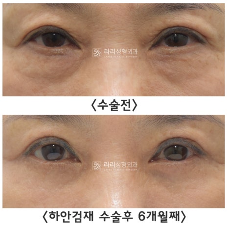 [라리성형외과] 하안검성형 VS 눈밑지방재배치(제거) : 어떤 수술을 해야 할까? 관련 이미지 6