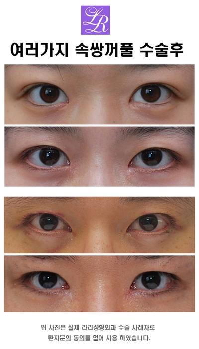Double eyelid surgery with an inner crease as charming as an outer crease image 4