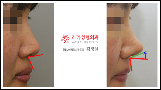 코끝성형 + 고양이수술 (비순각수술)이 뭔지 알려주는 전후 관련 이미지 2