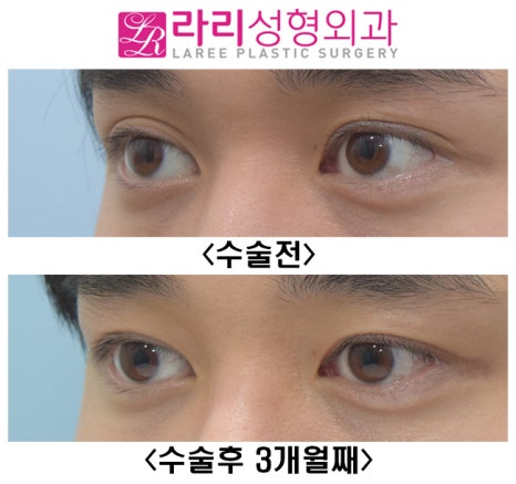 [라리성형외과] 자연 짝눈, 속쌍꺼풀 쌍꺼풀없애기로 짝짝이교정 관련 이미지 3