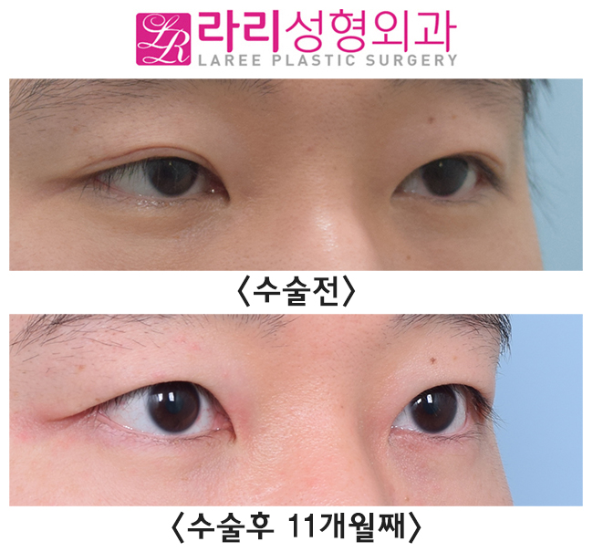[Lari Plastic Surgery] Triple Set: Asymmetric Eye Correction + Ptosis Correction + Removing Double Eyelids! image 3