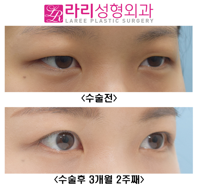 [라리성형외과] 여자도 무쌍눈매교정이 어울릴까? 관련 이미지 4