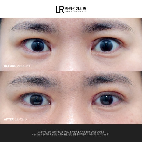 [라리성형외과]  부리부리한 사백안 눈 토안, 이런 눈도 교정 가능할까요 ? 관련 이미지 2