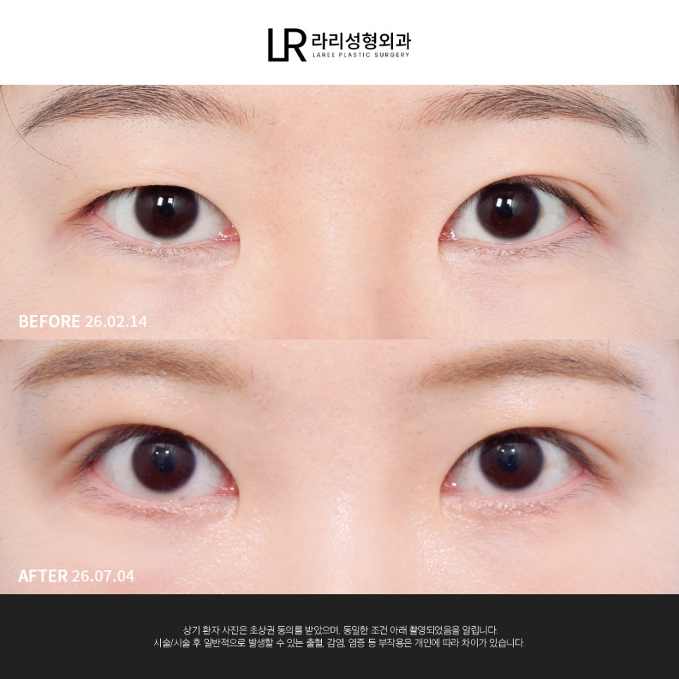 [라리성형외과] 눈 첫성형은 빠르고 간단한 매몰쌍수로 관련 이미지 1
