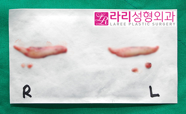 [Lari Plastic Surgery] Lower blepharoplasty including entropion correction, the most common cause of iatrogenic ectropion image 4