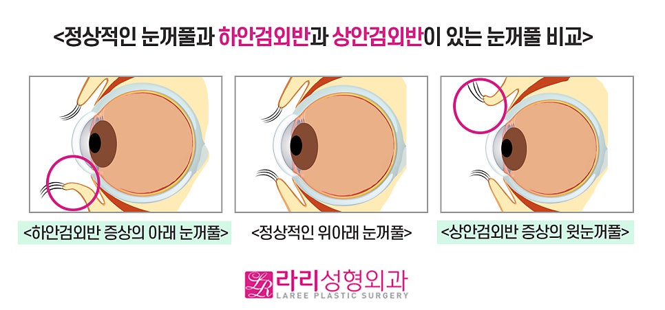 [라리성형외과] 쌍꺼풀수술 후 나타나는 안검외반 (상안검외반) 관련 이미지 1