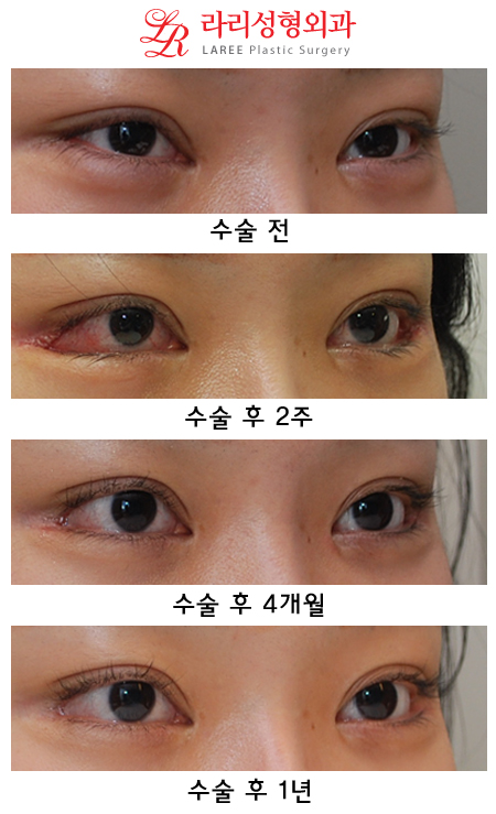 뒤트임재수술 처음과는 다른 뒷트임 후기 관련 이미지 2