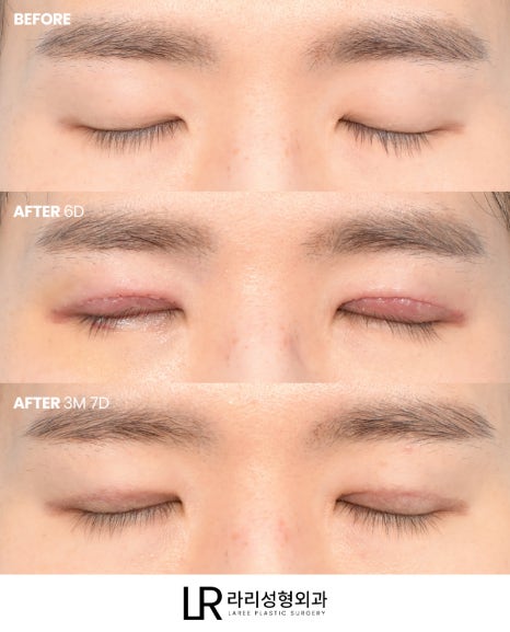 [Lari Plastic Surgery] Swelling After Double Eyelid Surgery: Why Does It Go Down Differently on Each Side? Will It Eventually Even Out? image 8