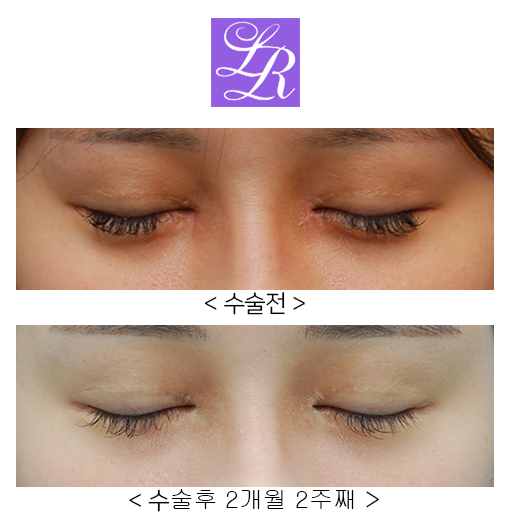 비절개눈매교정,눈꼬리내리기뒤트임 (졸린눈, 화난눈 교정) 관련 이미지 2