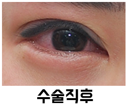 Swelling and Results Judged from Photos in Non-Incision Eye Correction Reviews image 2