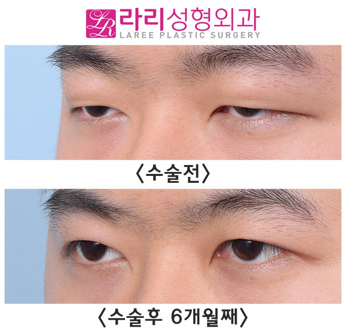 [Lari Plastic Surgery] Before-and-After Comparison Photos of Incisional Eye Correction Surgery That Restores Vision — Not from an Ophthalmology Clinic, but from a Plastic Surgery Clinic image 5