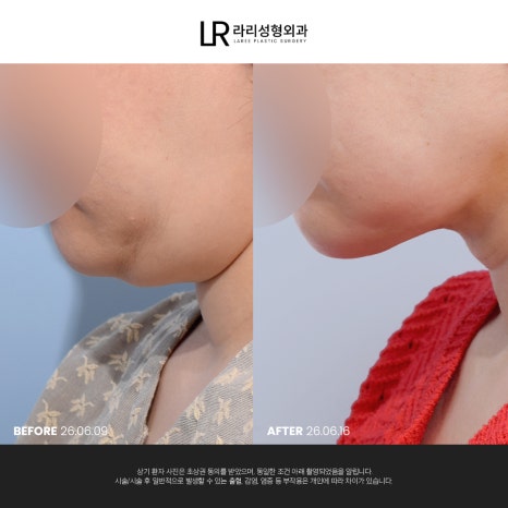 [라리성형외과] 이중턱 지방 흡입만으로는 아쉬운 얼굴 라인, 이중턱 근육 묶기도 같이 하면 효과가 두 배! 관련 이미지 11