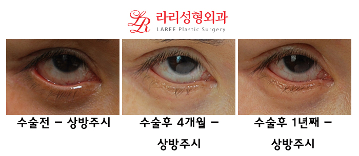Complications of Lower Blepharoplasty: Ectropion Correction (Senile, Traumatic, Iatrogenic) image 8
