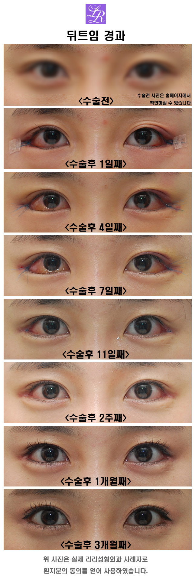 뒤트임수술, 부작용이 많은 수술일까? 관련 이미지 2