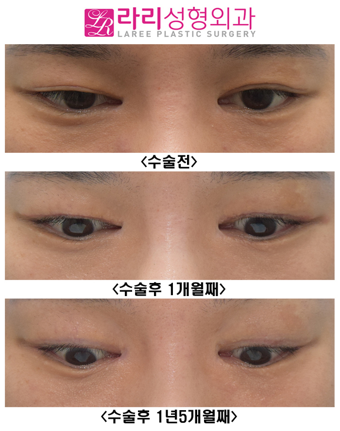 [Rari Plastic Surgery] Watching the Progress Before and After Double Eyelid Removal Surgery image 2