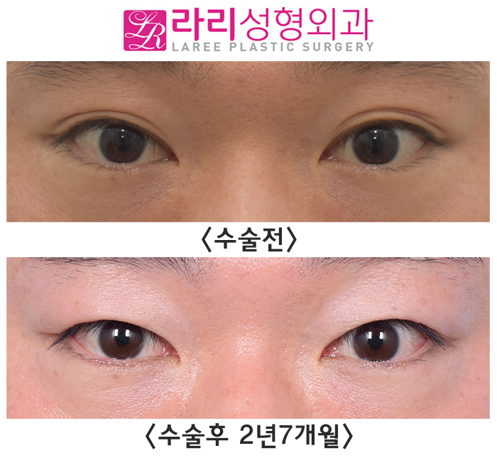 [라리성형외과] 자연쌍꺼풀없애기 2년 이상 장기 경과 전후 사진 관련 이미지 4