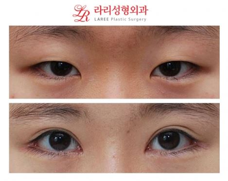 ☆왕눈이 수술 전후사진☆ 관련 이미지 1