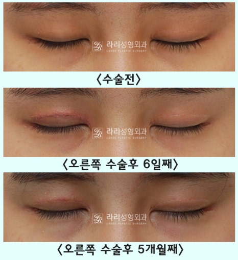 [Lari Plastic Surgery] One-sided double eyelid surgery to correct uneven eyes: Is it possible to get double eyelids on only one eye? image 8