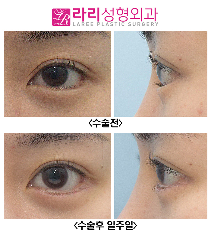 [라리성형외과] 속눈썹찔림, 안검내반교정수술이 필요할 때. 관련 이미지 4