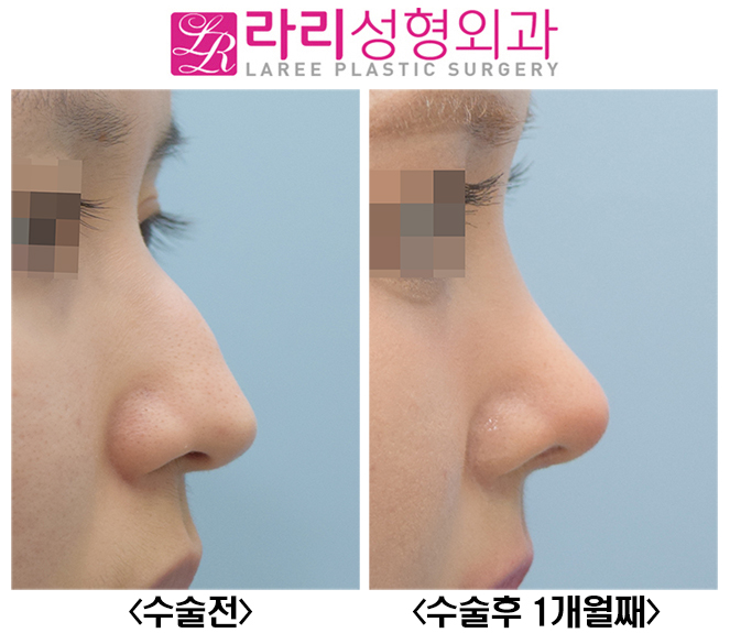 [라리성형외과] 매부리코수술, 무보형물로 자연스럽고 매끈하게 관련 이미지 3