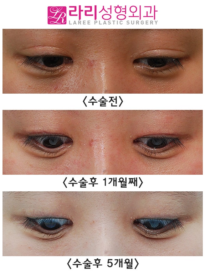 [라리성형외과] 쌍꺼풀없애는수술로 눈매교정과 짝눈교정을 한번에 (겉쌍에서 속쌍, 무쌍으로의 변화) 관련 이미지 3