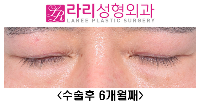 [Lari Plastic Surgery] Surgery to remove double eyelids only removes the double eyelids. image 4