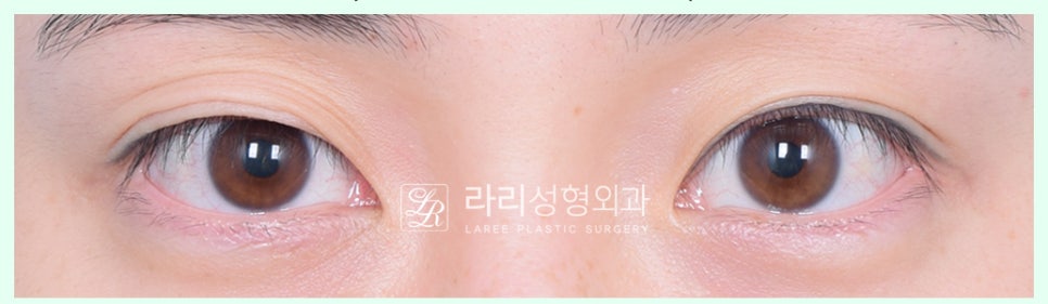 [Lari Plastic Surgery] Removing a Visible Double Eyelid (Double Eyelid Reversal Surgery), From Natural Double Eyelids to Surgical Double Eyelids: A to Z image 7