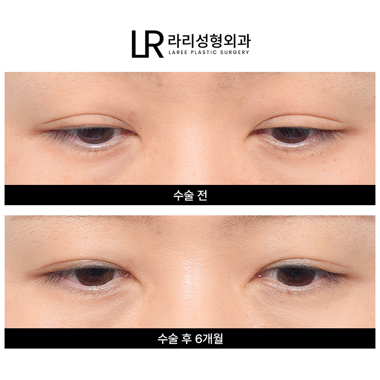 [라리성형외과] 흐릿한 눈, 소세지 쌍꺼풀 인라인 속쌍으로 깔끔하게 관련 이미지 2