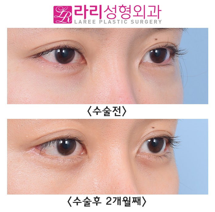 [라리성형외과] 다각도에서 바라보는 비대칭 뒤트임수술 관련 이미지 1