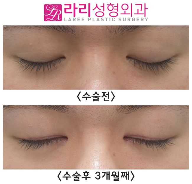 [라리성형외과] 남자다워지고 싶은 예쁜 자연 쌍꺼풀, 무쌍 만들기 관련 이미지 2
