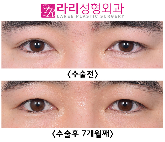 [라리성형외과] 자연쌍꺼풀 비대칭 교정 쌍꺼풀없애기 수술 전후 사진 관련 이미지 4
