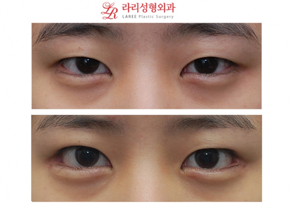 No-line monolid eye correction, downturned outer corner epicanthoplasty revision before-and-after photos image 1