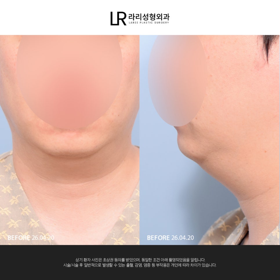 [라리성형외과] 이중턱 지방 흡입만으로는 아쉬운 얼굴 라인, 이중턱 근육 묶기도 같이 하면 효과가 두 배! 관련 이미지 1