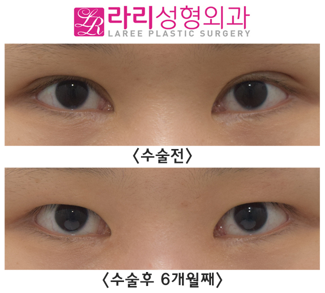 [라리성형외과] 함몰눈의 쌍꺼풀없애기 수술 전후 관련 이미지 1