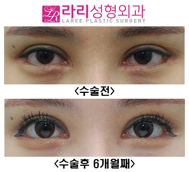 [라리성형외과] 적당한 앞트임 복원, 복원수술 전후 모양 관련 이미지 1