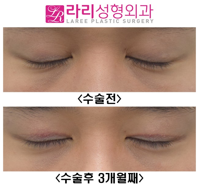 [라리성형외과] 자연 짝눈, 속쌍꺼풀 쌍꺼풀없애기로 짝짝이교정 관련 이미지 4