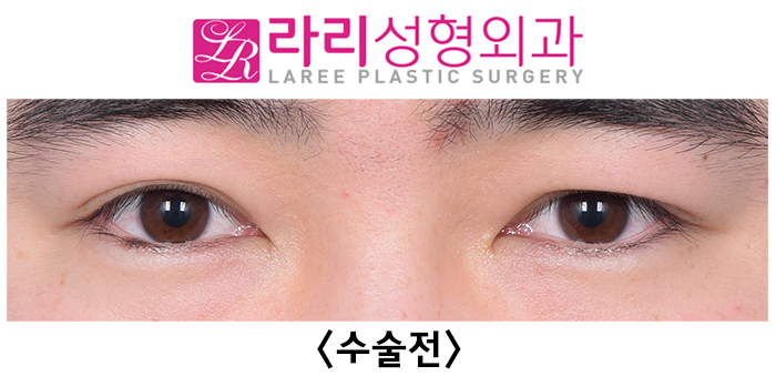 [라리성형외과] 자연쌍꺼풀 비대칭 교정 쌍꺼풀없애기 수술 전후 사진 관련 이미지 1