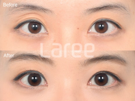 [Lari Plastic Surgery] Eyelid Fat Grafting for Improving the Eyelid Hollow: Incision Method vs. Non-Incision Method image 6