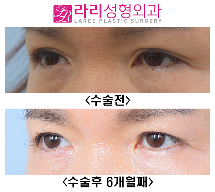 [라리성형외과] 여자도 쌍꺼풀없애기 - 함몰눈에 어울리는 눈 관련 이미지 3