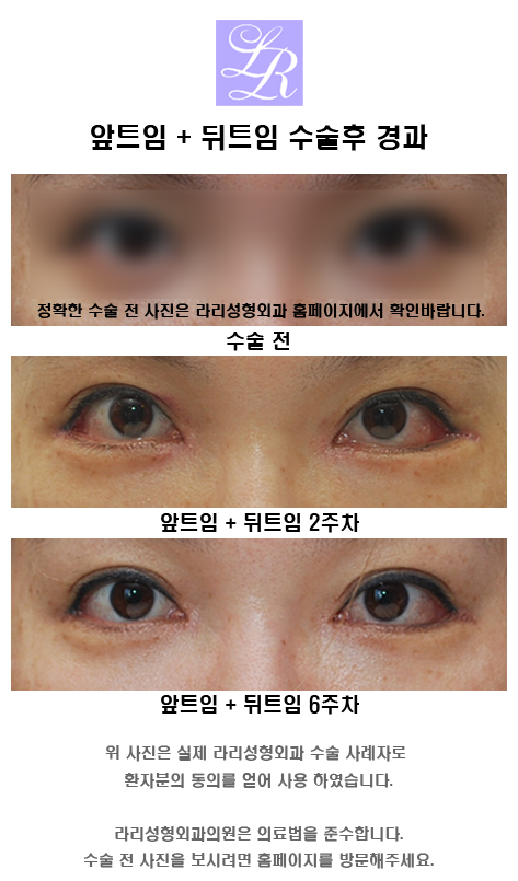 앞트임전후 많이 보면 도움이 될까 관련 이미지 4