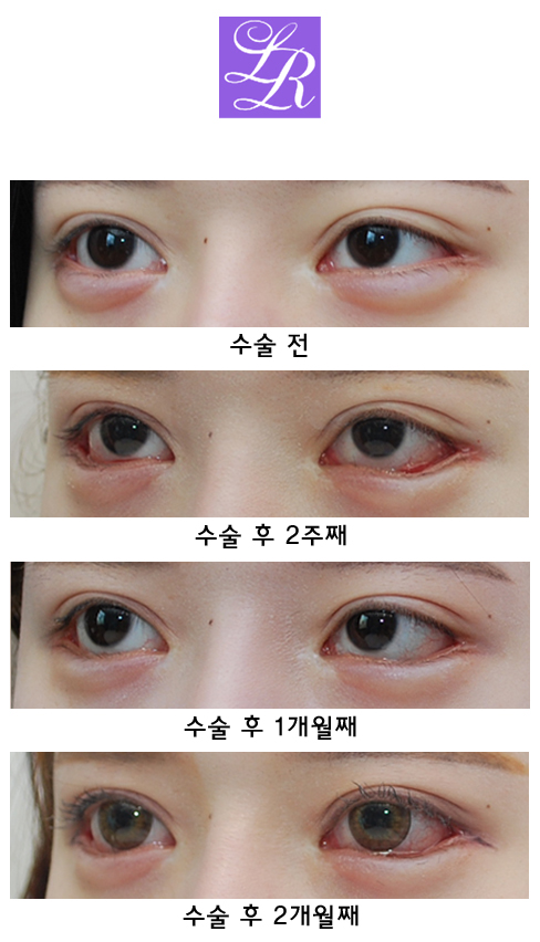 Long-Term Follow-Up Review Confirming the Effect of Lower Canthoplasty image 5