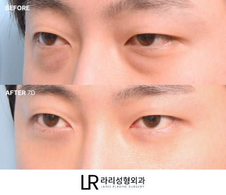 [라리성형외과] 하루(1DAY) 투자로 예뻐지는 라리성형외과의 퀵 눈밑지방재배치수술 관련 이미지 9
