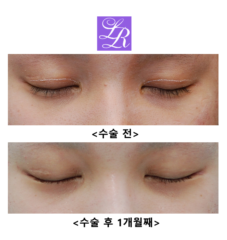 Before and After Lateral Canthoplasty (Close-up Photos - Scar at the Outer Corner Visible!) image 4
