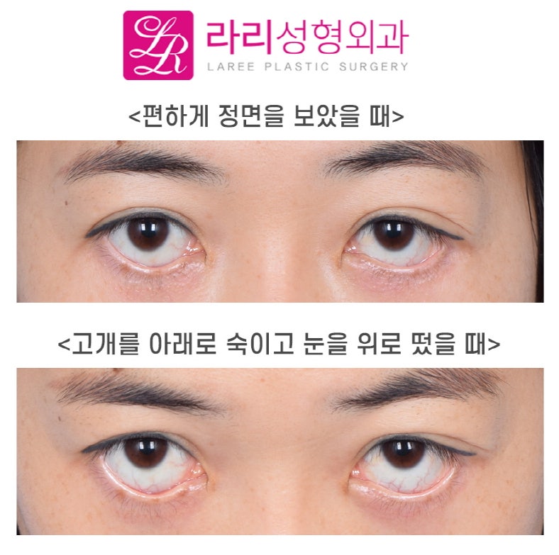 [Laree Plastic Surgery] My Eyelid Margin Is Turned Out—Could This Be Ectropion?!! (Self-Check by Symptoms) image 3