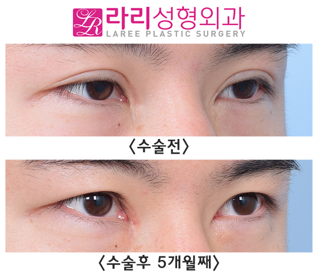 [Lari Plastic Surgery] Removing an Overly Outer-Corner Double Eyelid Line with Epicanthoplasty image 2