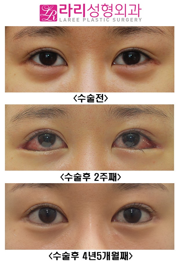 [라리성형외과] 눈이 확 커지는 눈꼬리내리기뒤트임을 원한다면 장기 경과 수술 전후 사진을 함께 봐야 합니다. 관련 이미지 2