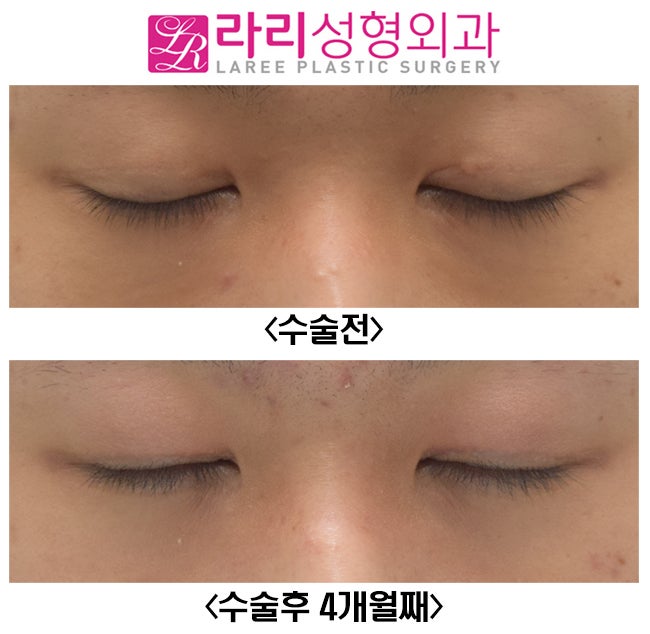 [라리성형외과] 쌍꺼풀없애기 그리고 눈두덩이 꺼짐 교정 (루프지방이식) 관련 이미지 6