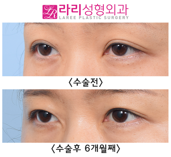 [라리성형외과] 흐릿한 눈, 소세지 쌍꺼풀 인라인 속쌍으로 깔끔하게 관련 이미지 1